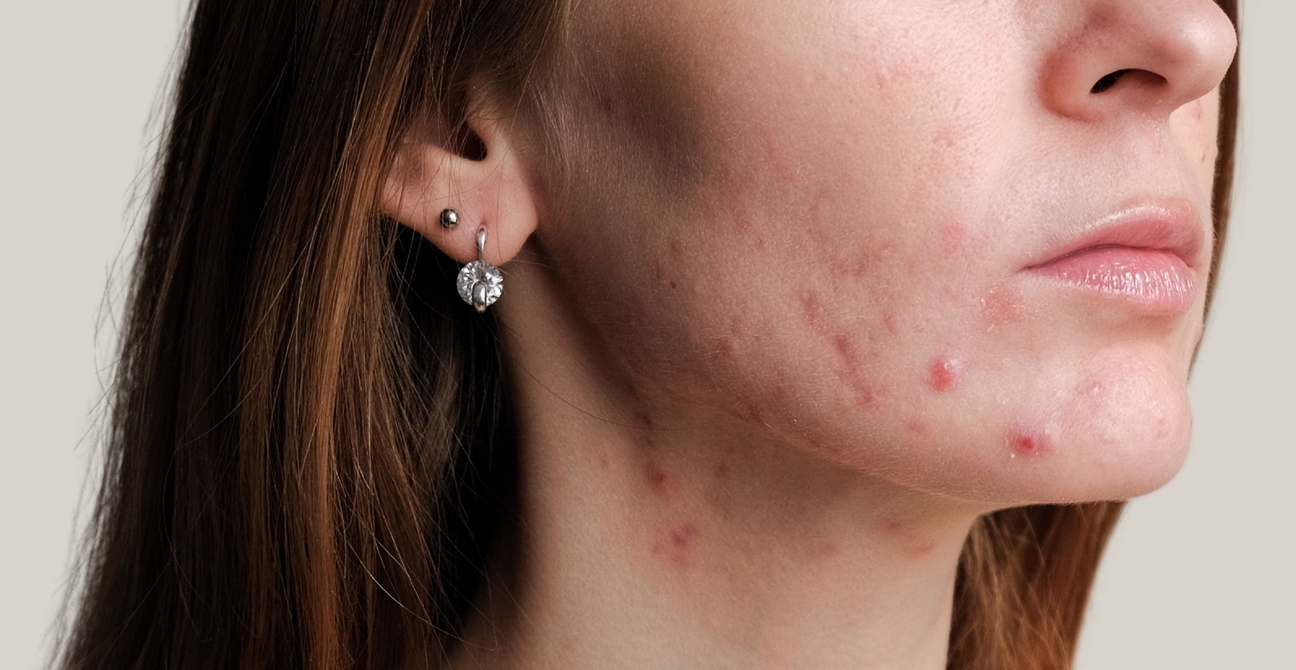 Menopausal Acne Common Triggers and Effective Treatments Blog